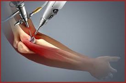 Elbow Replacement